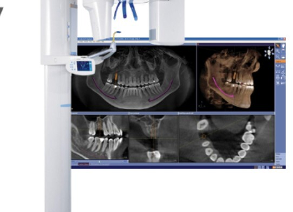 Dental imaging machine displaying detailed panoramic X-ray scans of teeth and jaw for diagnostic purposes.