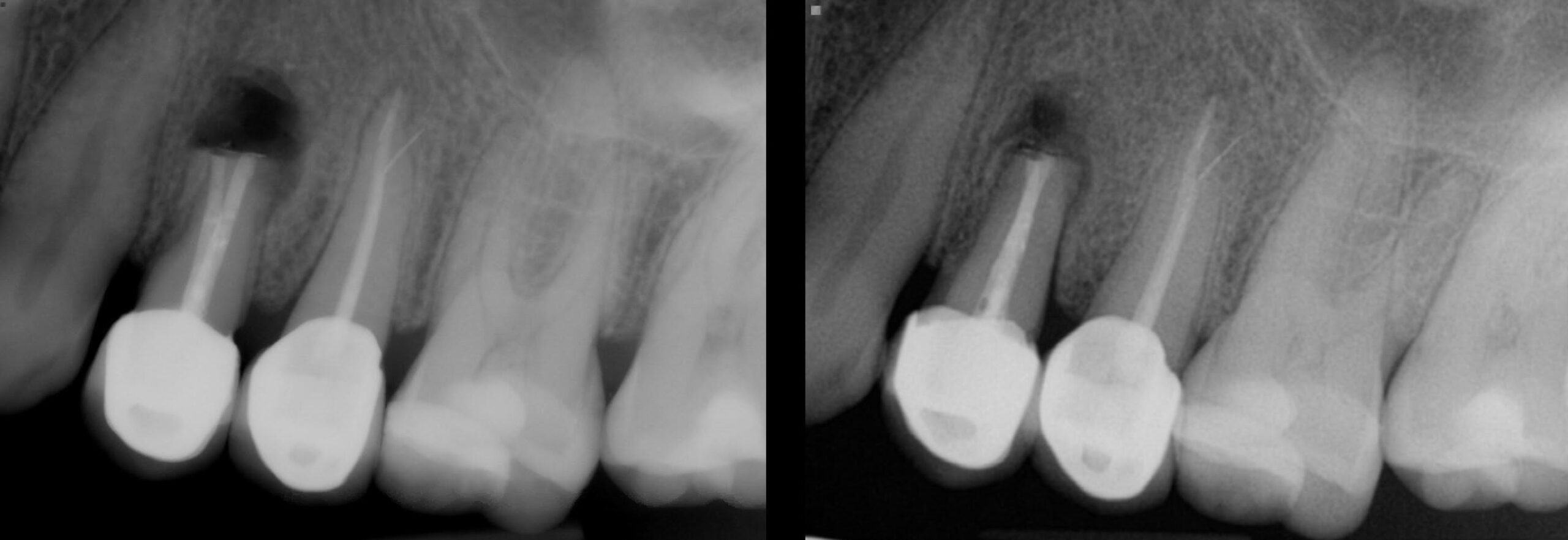Before and After X-rays