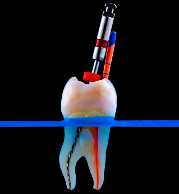 Dental tool and tooth illustration showing root canal procedure on black background.